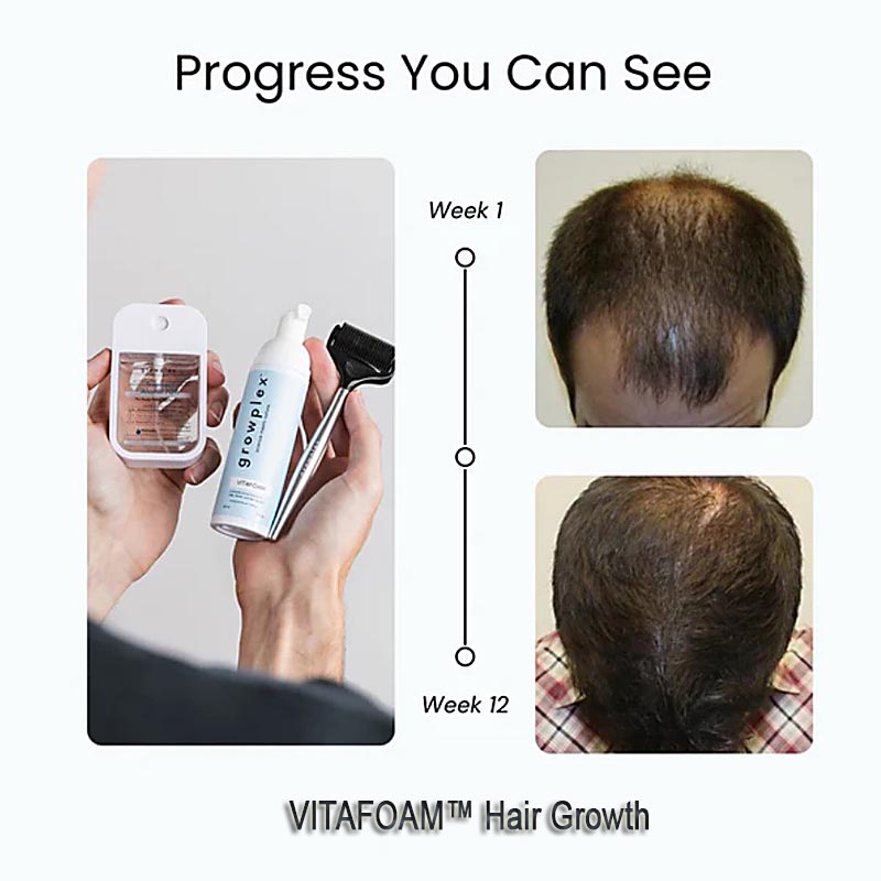 VITAFOAM™ Hair Growth Formula – Natural Hair Regrowth Product